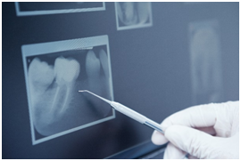X-rays and their importance in maintaining your dental health