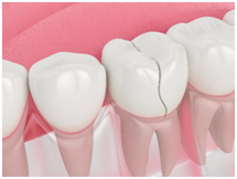 Options to repair a broken tooth