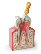Benefits of root canal treatment