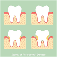 Pervent tooth clay