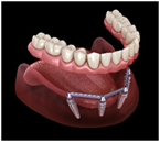 Dentures