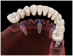 Dentures