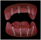 Dentures