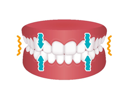 Bruxism