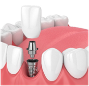 Dental implants
