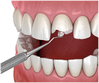 Options to repair a broken tooth