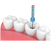 Root canal