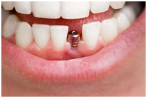 Dental implants