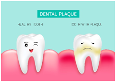 Dental Plaque