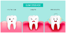 Gum disease