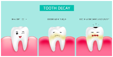 Tooth Decay