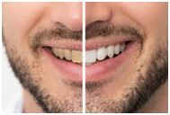 Teeth whitening