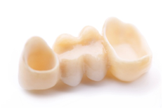 dental bridge
