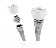 dental implant