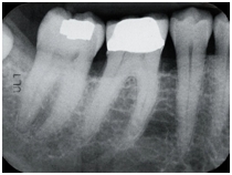 fillings