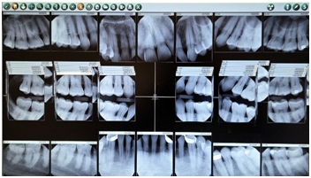 types of dental X-rays
